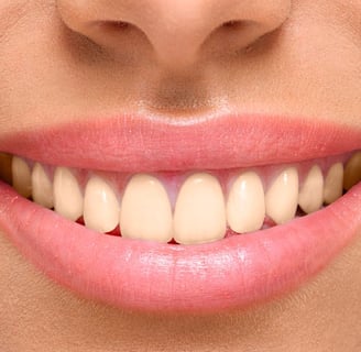 sorriso antes do clareamento