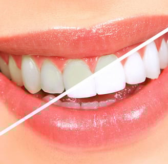 clareamento dental 1
