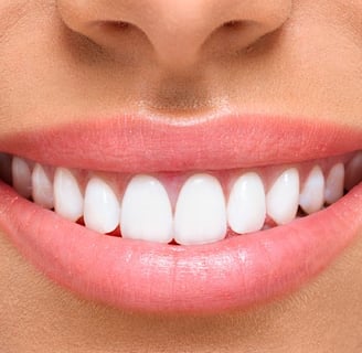 sorriso depois do clareamento