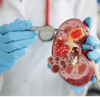 kidney showing stone crystals