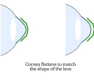 orthokeratology-cornea-reshaping-overnight