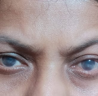 severe-dry-eyes-scleral-lens