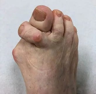 Hallux Valgo