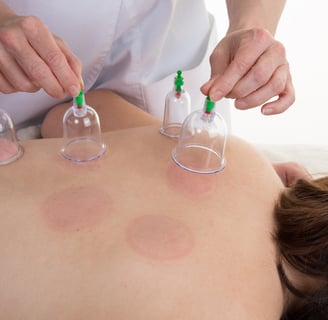 Cupping