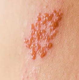 herpes zoster meaning in urdu