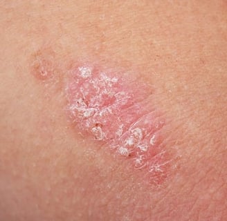 psoriasis meaning in urdu