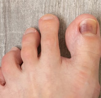 ногтевой грибок на ногтевой пластине на ноге