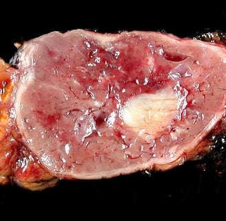 Pheochromocytoma