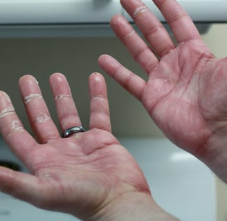 Palmar Erythrodysesthesia