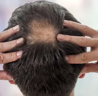 How Does Caffeine Shampoo Combat Hair Loss?