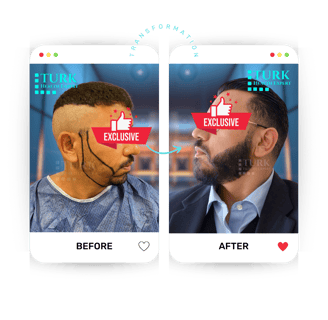 Celebrities Beard Transplant
