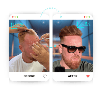Celebrities Hair Transplant