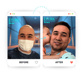 Celebrities Hair Transplant