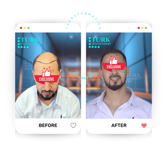 Celebrities Hair Transplant