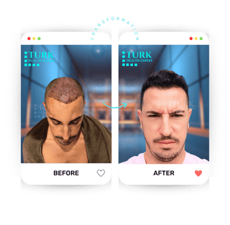 Celebrities Hair Transplant