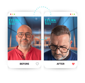 Celebrities Hair Transplant