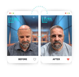 Celebrities Hair Transplant