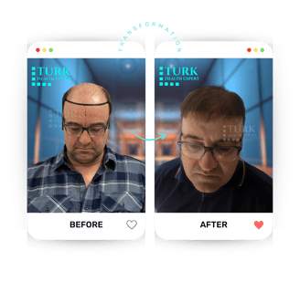 Celebrities Hair Transplant