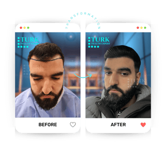 Celebrities Hair Transplant