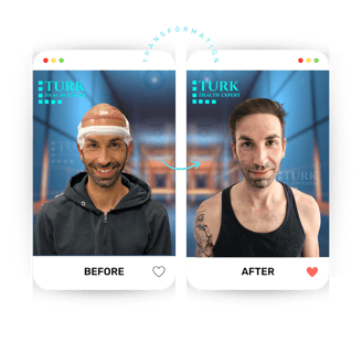 Celebrities Hair Transplant