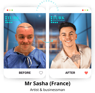 hair transplant before after