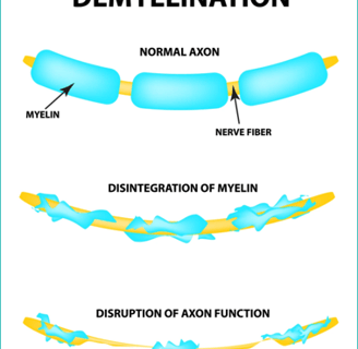 Damaged nerves