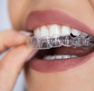Invisalign Clear Aligners in Naples FL — Benefits, Process & Cost with Dr. Kristina Taranov DDS