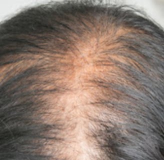 Balding Head 