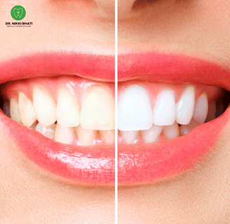 A bright and healthy smile achieved through professional tips from teeth whitening dentist