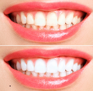 Close-up of a radiant smile after teeth whitening, showcasing bright, white teeth.
