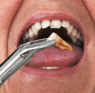 dentist carefully extracting a damaged tooth using dental instruments in a clinical setting."