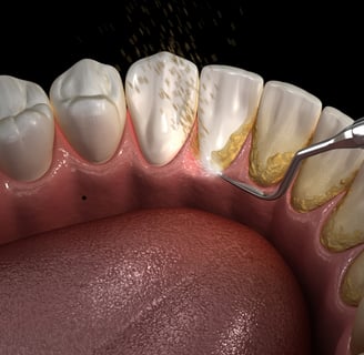 Dentist using specialized tools for scaling and root planing to treat gum disease