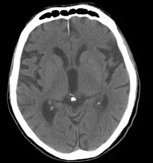 Brain sand or Corpora arenacea. 