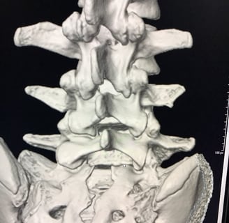 reconstruccion 3d de columna lumbar y sacra