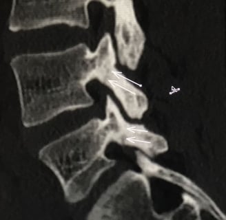 espondilolisis en columna lumbar