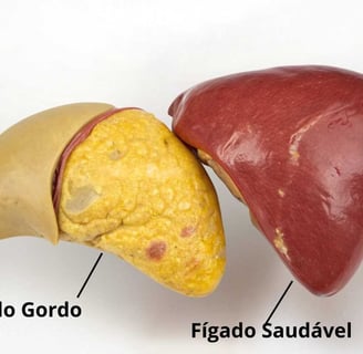Comparação visual entre um fígado saudável e um fígado com esteatose hepática (gordura no fígado
