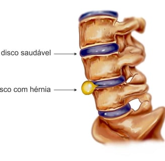 um desenho mostrando como funciona a hérnia de discona coluna