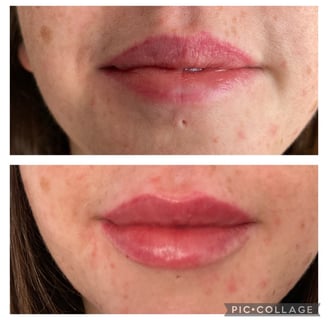 Teoxane Lip Filler 