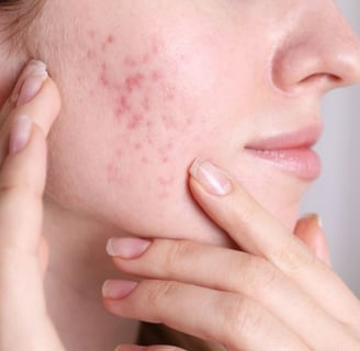 woman with acne