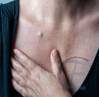 xérese de Cistos Sebáceos, Lipomas e Nevus, sintomas e quando preocupar