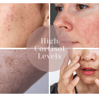 skin conditions linked to high cortisol