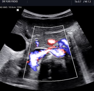 Artéria Renal Direita no Doppler em paciente sem patologias.