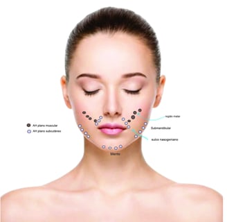 Cartografia facial com depósitos de Ácido Hialurônico