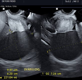 Endometriomas em paciente com dispareunia e dismenorreia