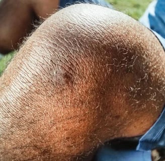 rotura de menisco dónde duele