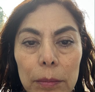 Face Yoga Result - Before