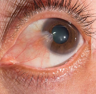 pterígio, pterigio, cirurgia de pterigio, imagem mostrando pterigio, carne crescida nos olhos, são paulo