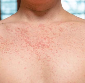 Measles Outbreak