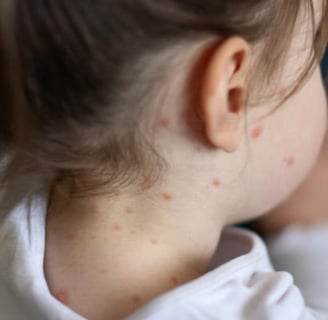 Texas Measles Outbreak