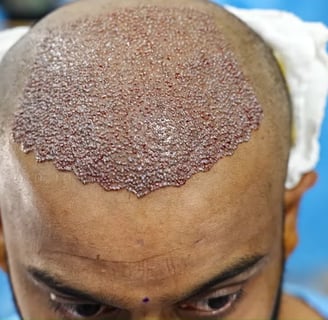 Hair Transplant